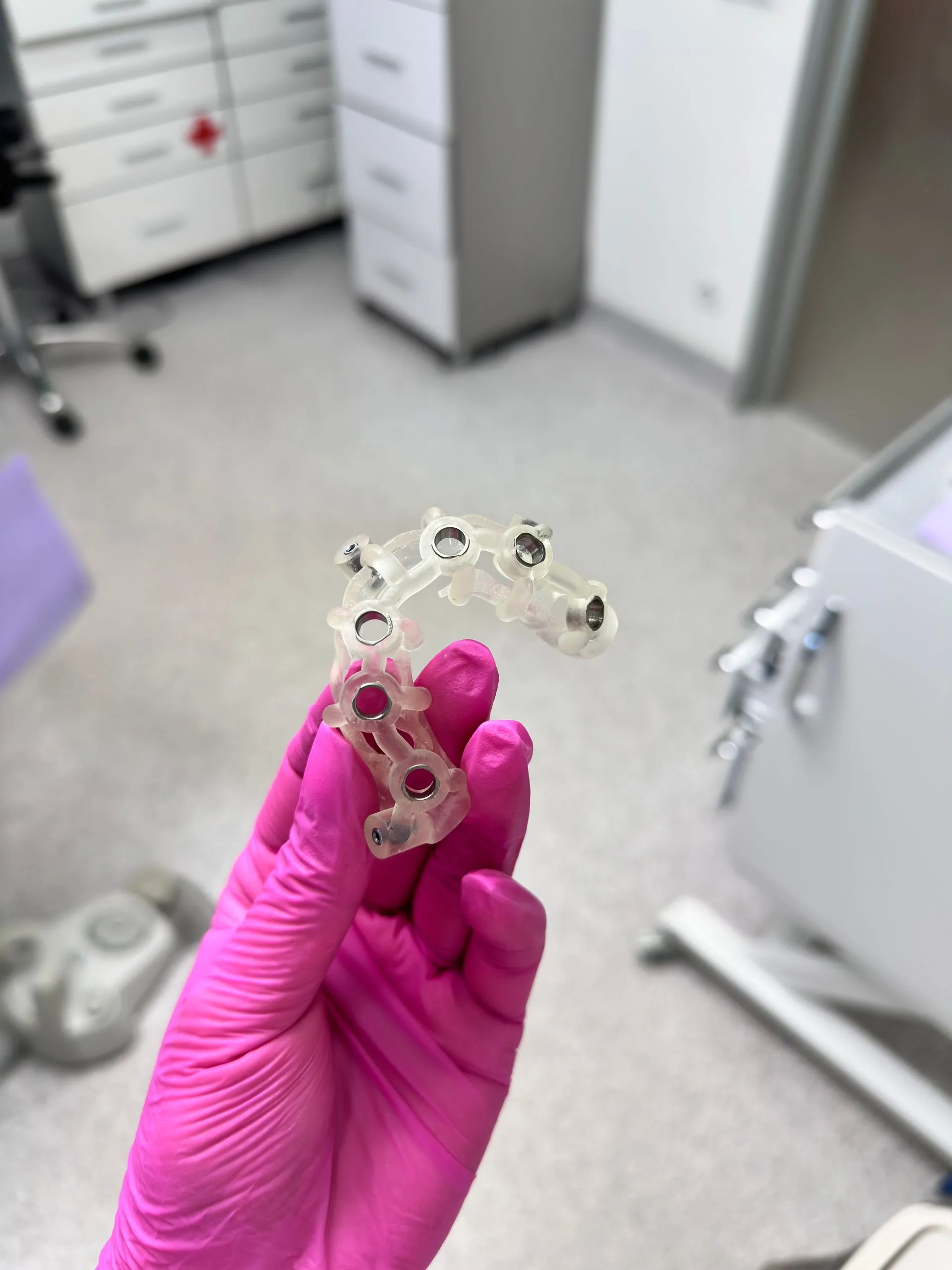 Modelo de un implante dental integrado en la encía, tratamiento de Clínica Dental Vigoar